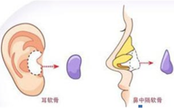 耳软骨隆鼻手术时间一般需要多久？
