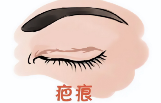 如何去除割双眼皮后产生的增生疤痕？