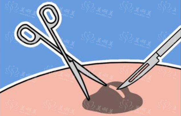 冷冻去痣疼吗？调节原理是什么呢？