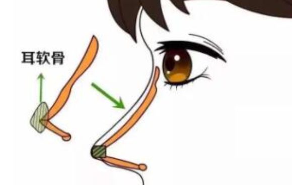 软耳骨隆鼻手术后需要多长时间才能恢复？