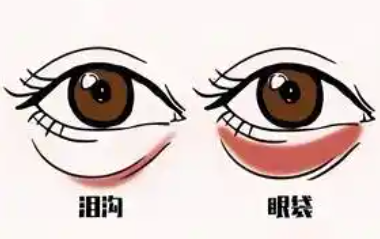 探索超声波去眼袋：效果与优势的深度解析