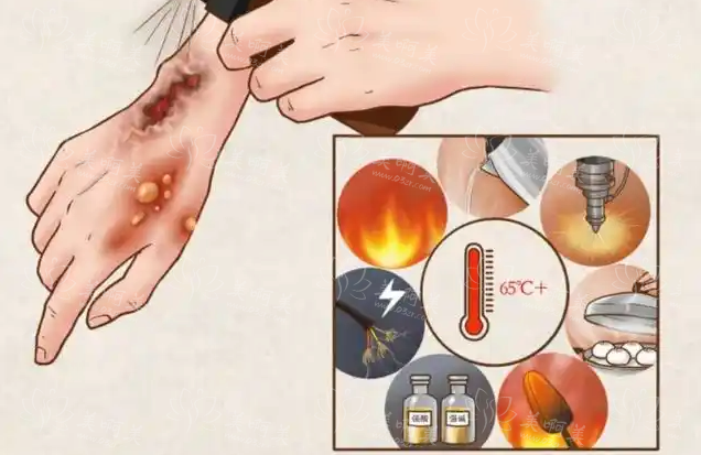 烫伤疤痕修复多久能愈合?关键看这 3 点