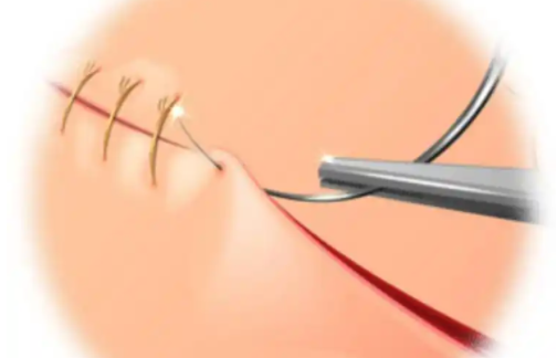 脸上缝针后的疤痕能否完全去除?