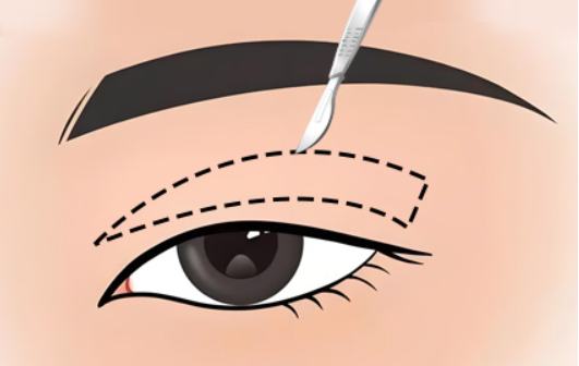 双眼皮手术前，这些关键因素你考虑过吗?