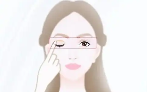 埋线双眼皮术后出现淤青该如何消除?