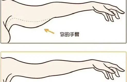 手臂吸脂手术的结果究竟如何? 手臂吸脂手术的结果究竟如何?
