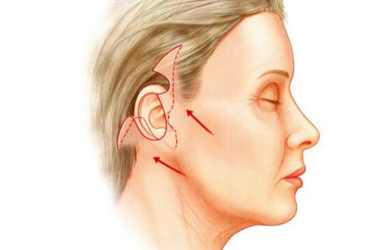 小切口拉皮手术几天能恢复好？
