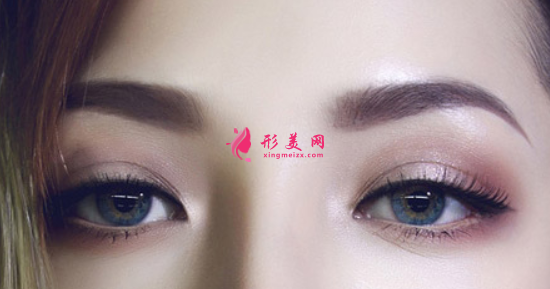 埋线双眼皮怎么快速恢复