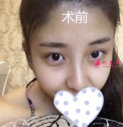 南方整形美容医院胡志奇做双眼皮真人案例欣赏
