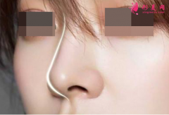 隆鼻假体需要定时更换吗？