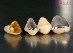 种植牙的价格需要多少钱？