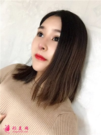 郑州膨体隆鼻术后恢复情况对比