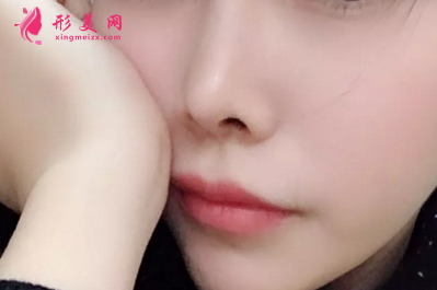 做鼻翼缩小手术要注意的事项