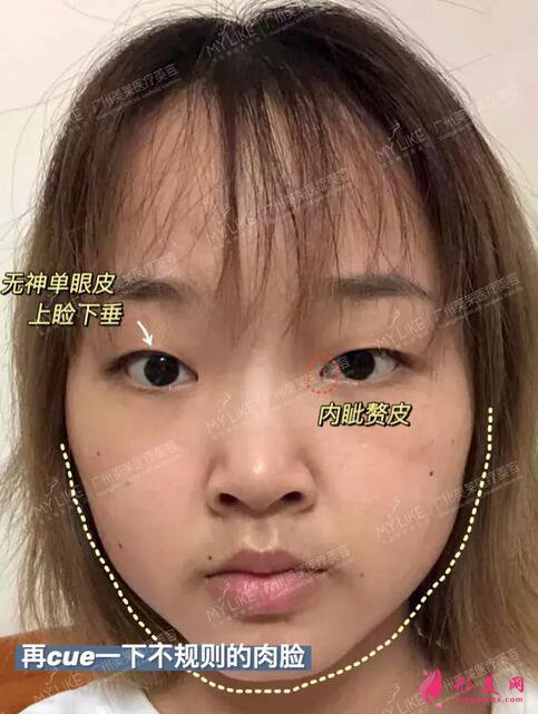 广州美莱双眼皮案例|单眼皮妹子30天の变美日记~