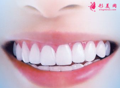烤瓷牙边缘变黑是怎么回事