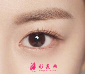 开眼角后疤痕增生怎么修复