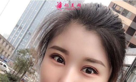 找上海美联臣李炅默做的双眼皮 40天术后效果恢复得简直太好了