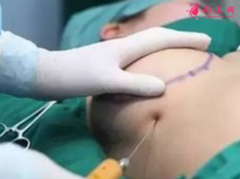 自体脂肪隆胸费用受哪些因素影响?