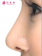 自体软骨隆鼻需要多久恢复好？