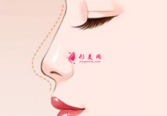 自体软骨隆鼻可以保持多长时间？