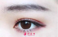 切开双眼皮老了会消失吗？