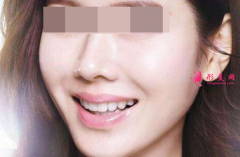 自体脂肪填充脸部一般多少钱？