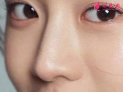 自体软骨隆鼻什么时候消肿？