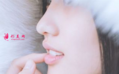 自体软骨隆鼻恢复期长吗？