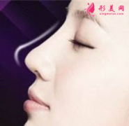 自体软骨隆鼻后会有血肿吗？