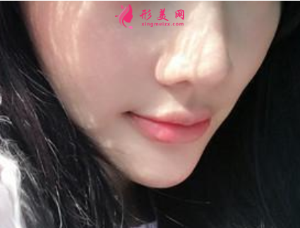 注射瘦脸针会不会有副作用呢