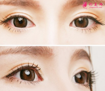 全切双眼皮的效果自然吗？