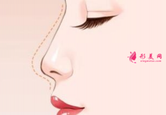 隆鼻假体取出后会怎么样？