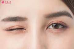 什么人不适合做切开双眼皮？