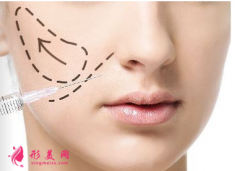 玻尿酸填充脸部怎么消肿？