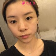 重庆军美医疗整形膨体隆鼻术后恢复情况对比图分享