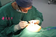 求科普呀~玻尿酸隆鼻到底好不好?理想吗