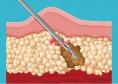 吸脂减肥会不会有血肿？