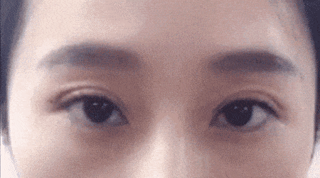 双眼皮修复后要怎么护理