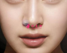 做软骨隆鼻可以保持多久？