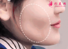 自体脂肪填充面部多少钱？