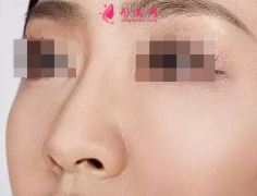 肋软骨隆鼻多久稳定下来?