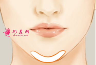 假体垫下巴大约多少钱