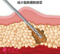 腰腹部吸脂需要多长时间消肿？