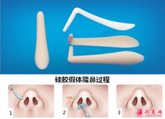 假体隆鼻大约是多少钱？