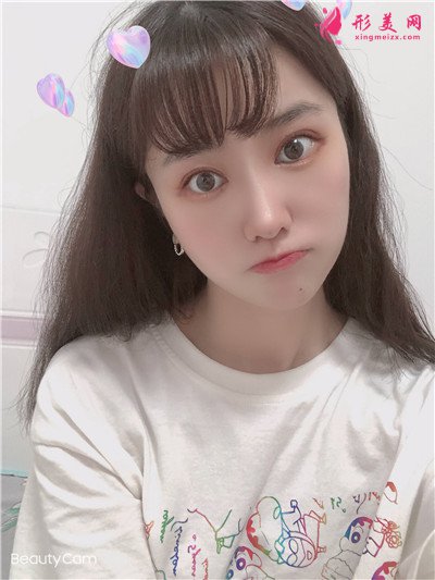 武汉眼部综合案例反馈，这样的双眼皮我好喜欢~