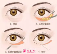 手术祛眼袋会反弹吗？
