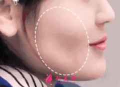 自体脂肪填充脸颊效果可以保持多久？