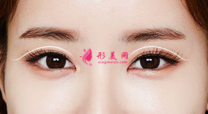 全切双眼皮术后注意事项