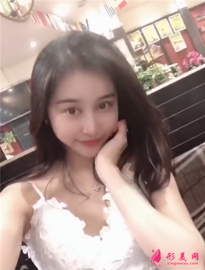 成都恒博种植发际线手术术后效果展示 术后 成都恒博种植发际线手术术后效果展示