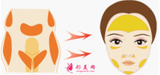 自体脂肪填充脸部脂肪存活率跟什么有关